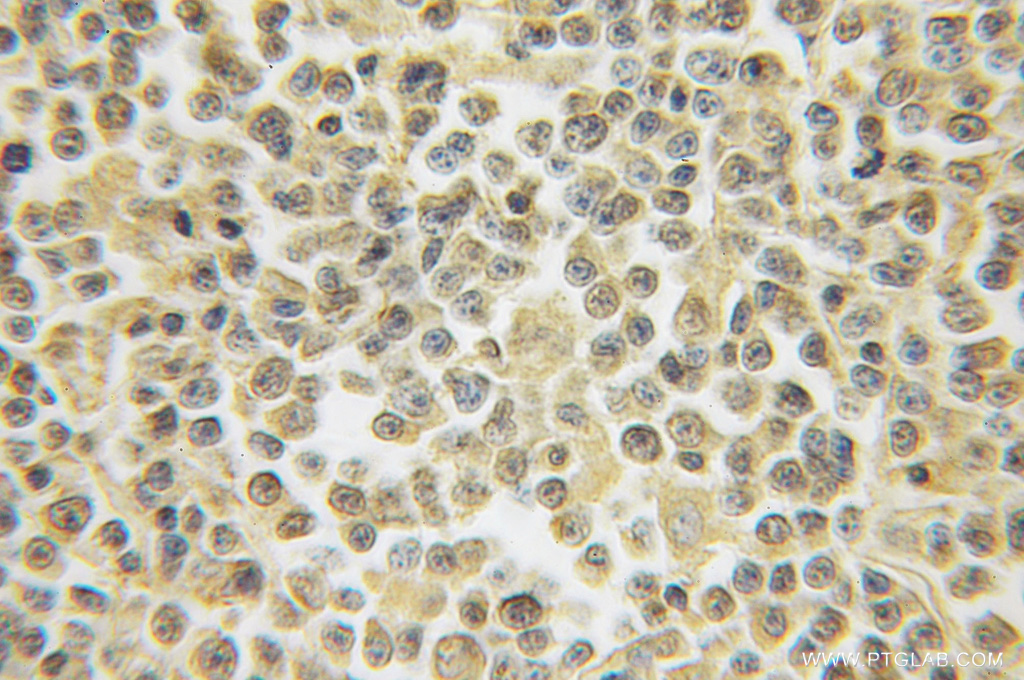 IHC staining of human lymphoma using 12453-1-AP