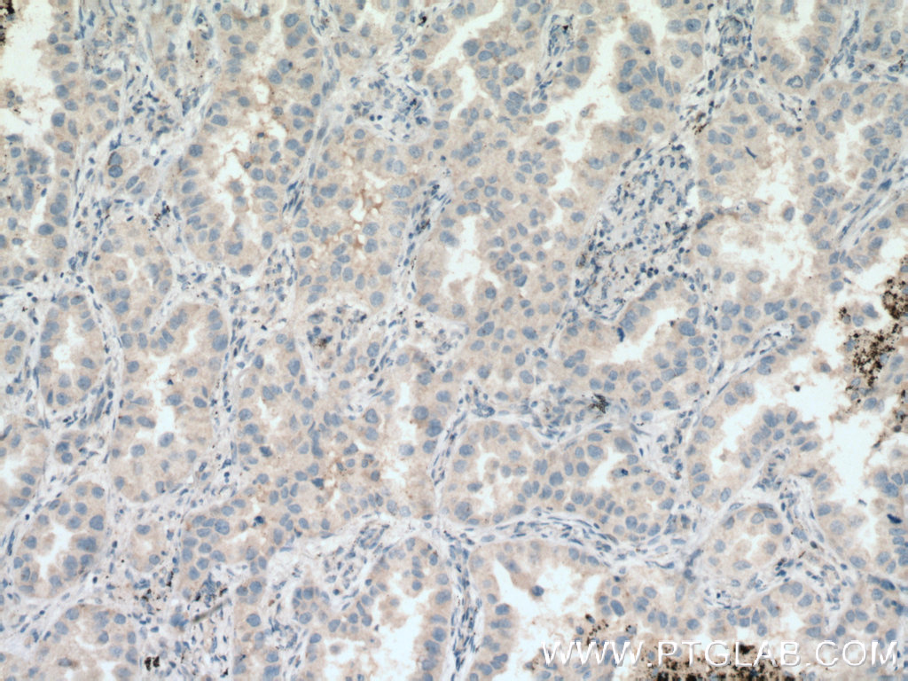 IHC staining of human lung cancer using 11855-1-AP