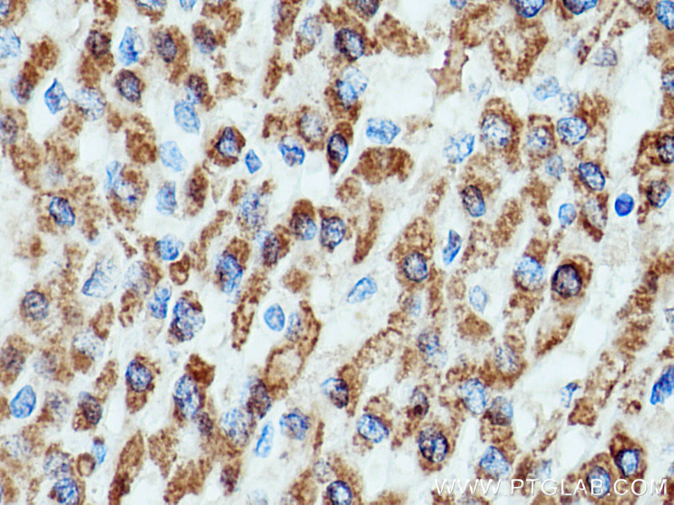 IHC staining of human liver cancer using 16752-1-AP