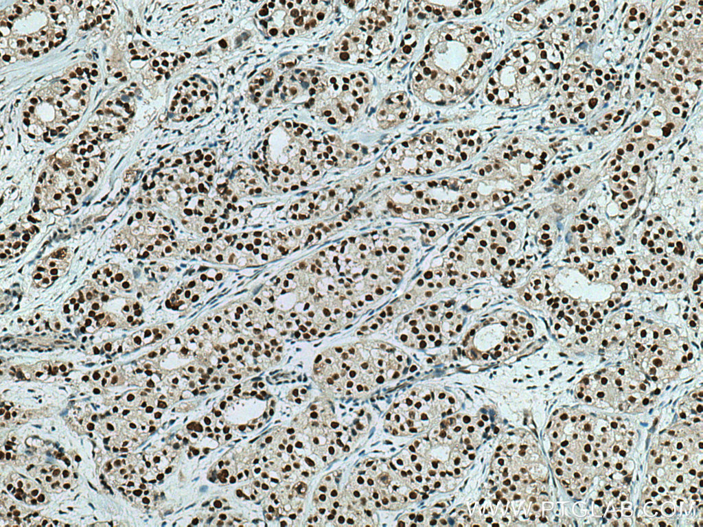 IHC staining of human breast cancer using 67189-1-Ig