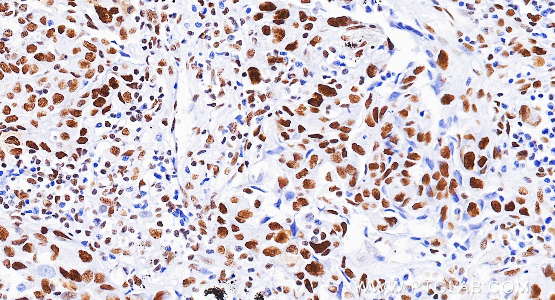 IHC staining of Human lung cancer (Adenocarcinoma) using 88318-1-RR (same clone as 88318-1-PBS) IHC staining of Human lung cancer (Adenocarcinoma) using 88318-1-RR (same clone as 88318-1-PBS)