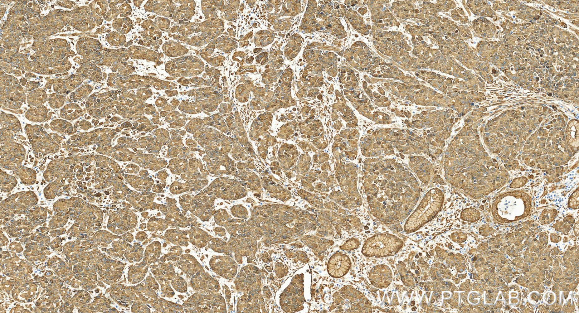 IHC staining of human stomach cancer using 80046-5-RR