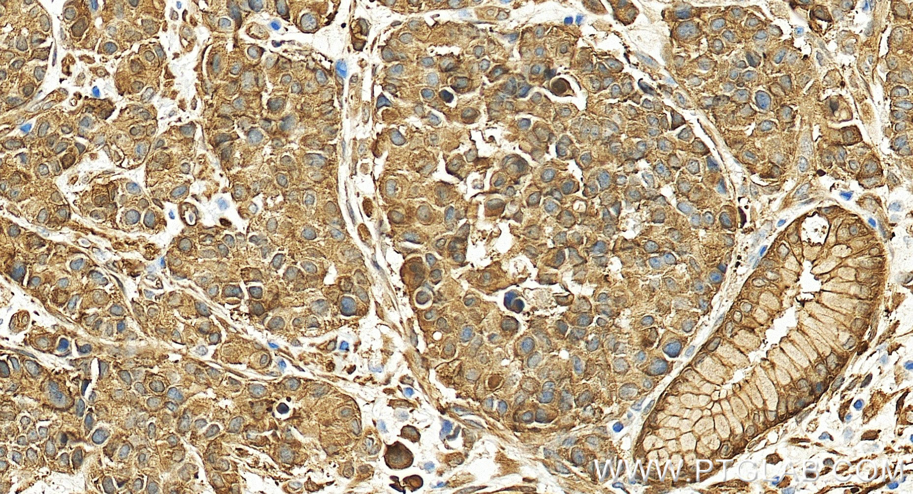 IHC staining of human stomach cancer using 80046-5-RR