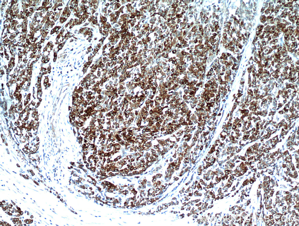 IHC staining of human colon cancer using 21206-1-AP