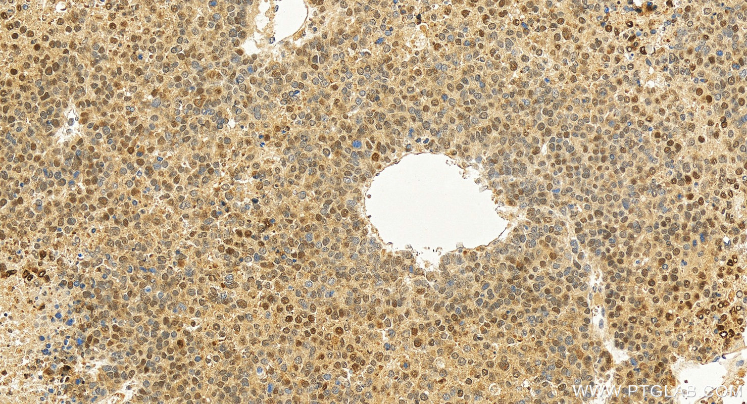 Immunohistochemical analysis of paraffin-embedded human hepatocellular carcinoma slide using 66183-1-Ig (HSP70 antibody) at dilution of 1:800 (under 20x lens). Heat mediated antigen retrieval with Tris-EDTA buffer (pH 9.0). IHC staining of human hepatocellular carcinoma using 66183-1-Ig
