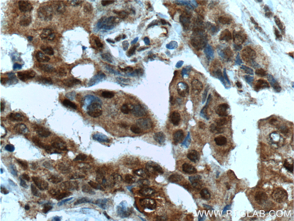 IHC staining of human breast cancer using 66183-1-Ig