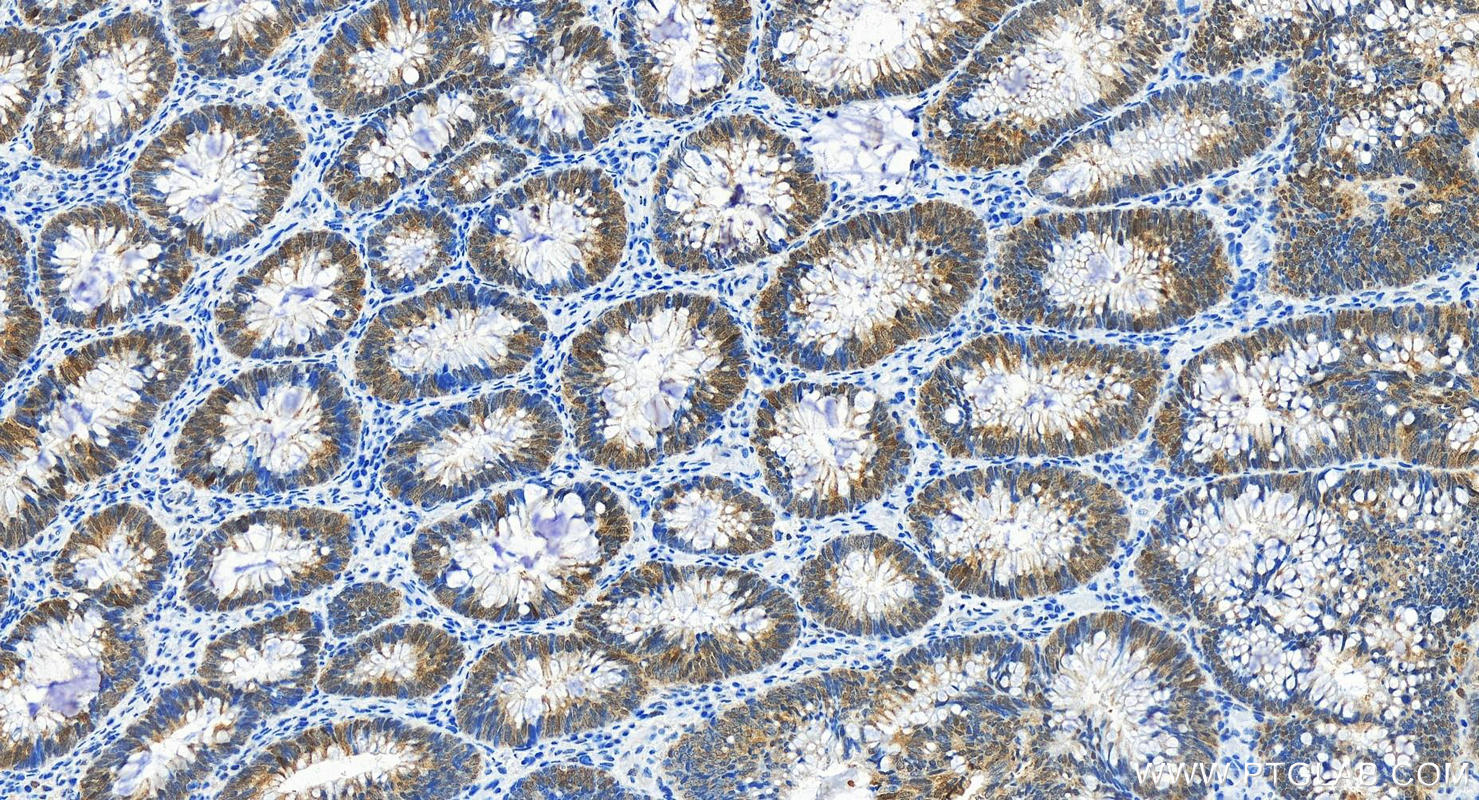 IHC staining of human colon cancer using 80735-1-RR