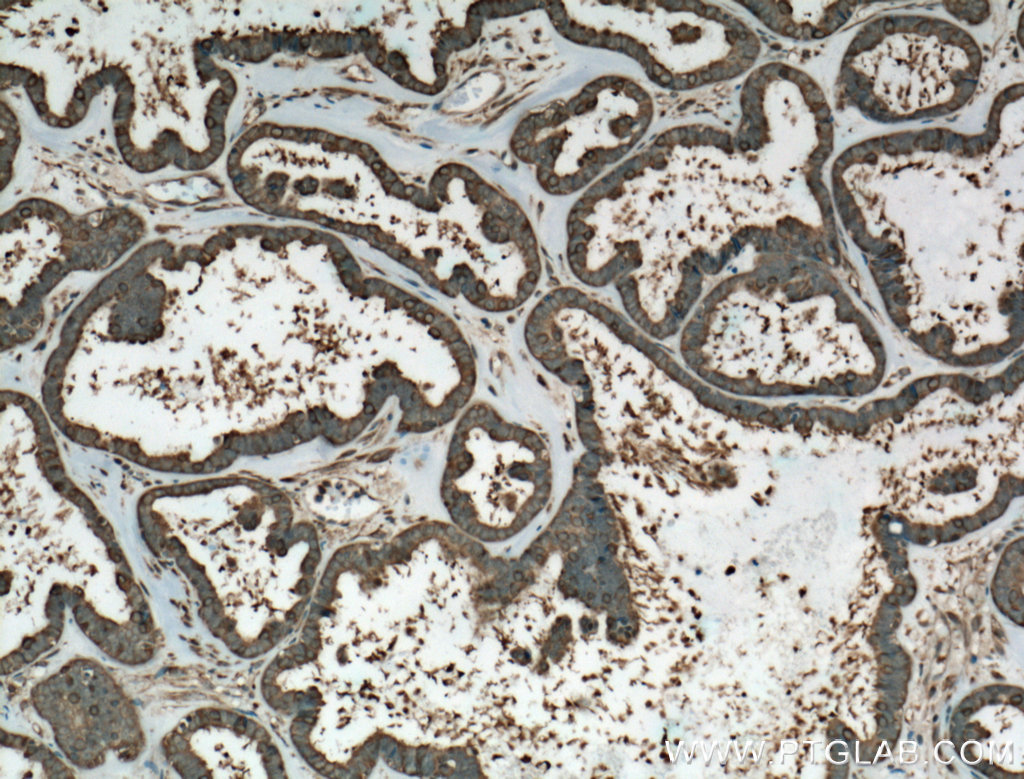 IHC staining of human ovary tumor using 60318-1-Ig