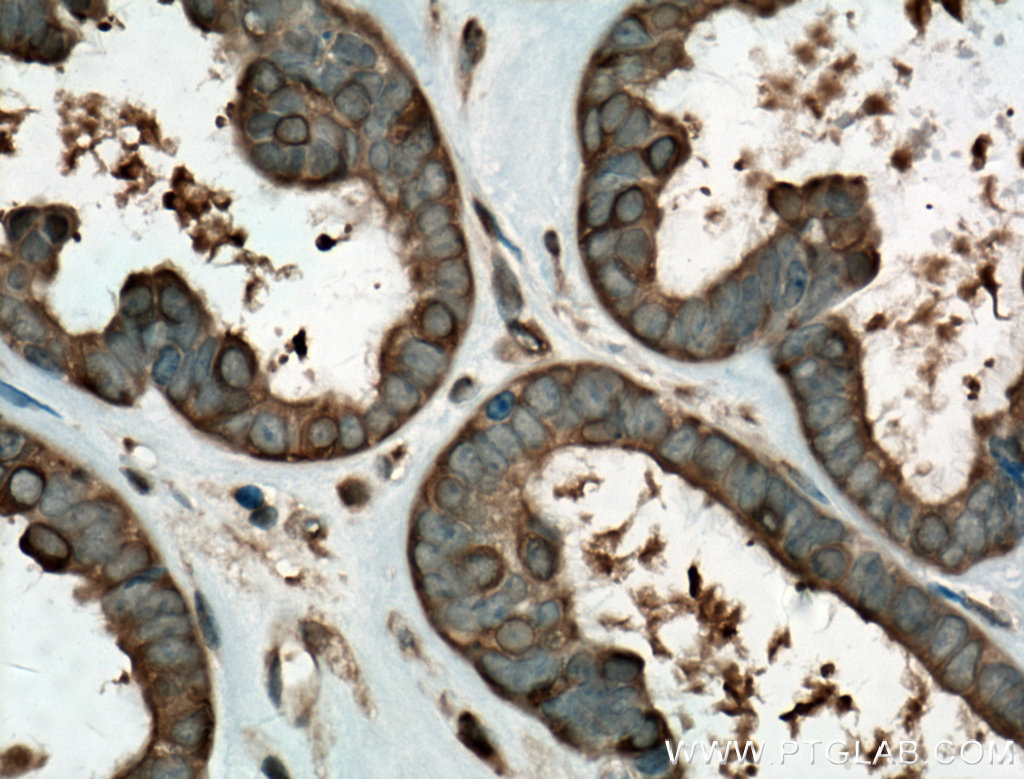 IHC staining of human ovary tumor using 60318-1-Ig
