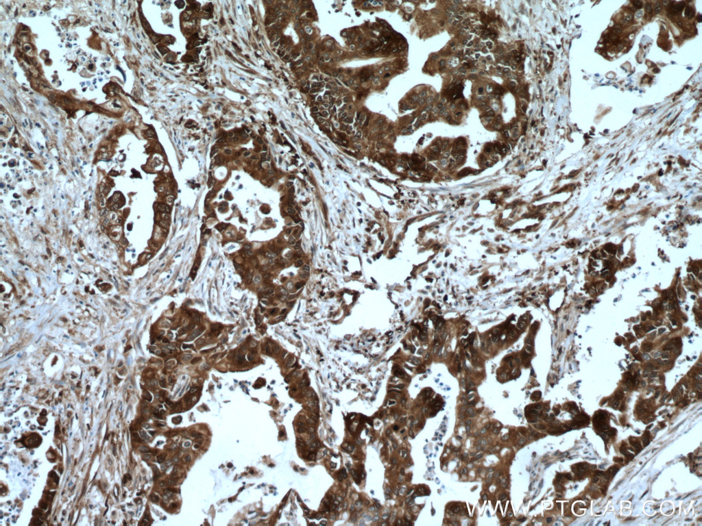IHC staining of human pancreas cancer using 11405-1-AP