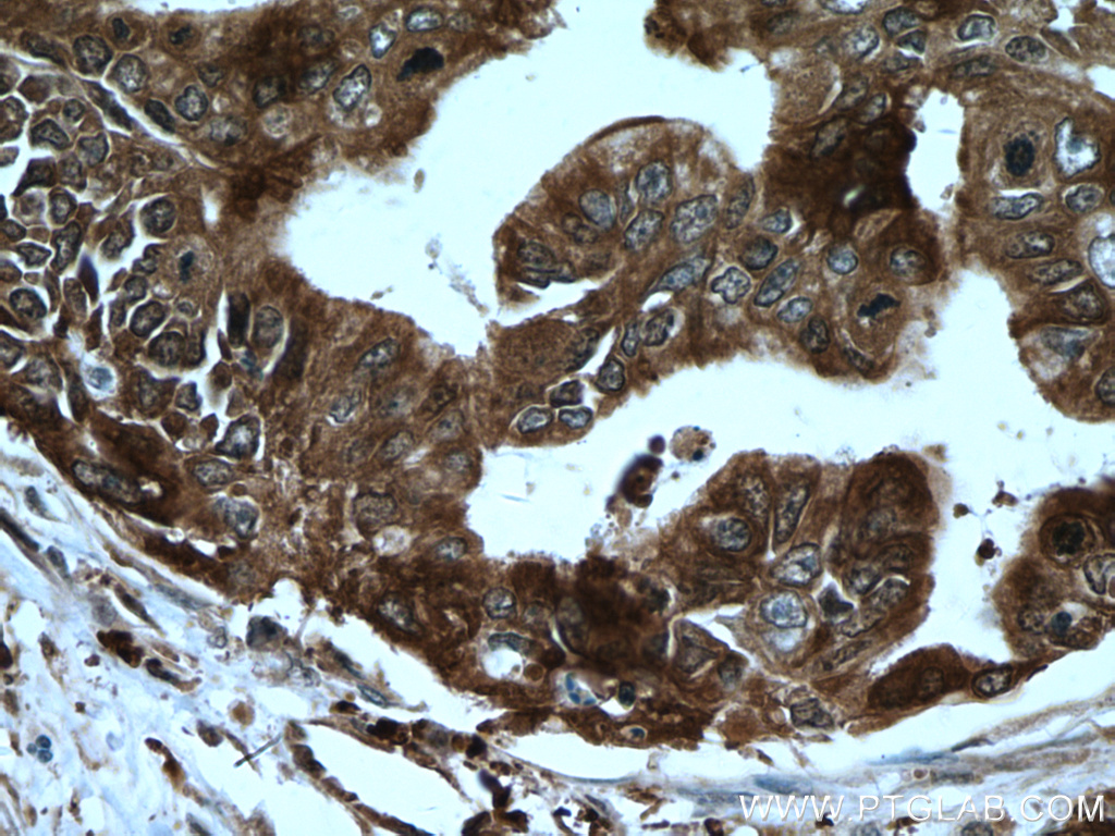 IHC staining of human pancreas cancer using 11405-1-AP