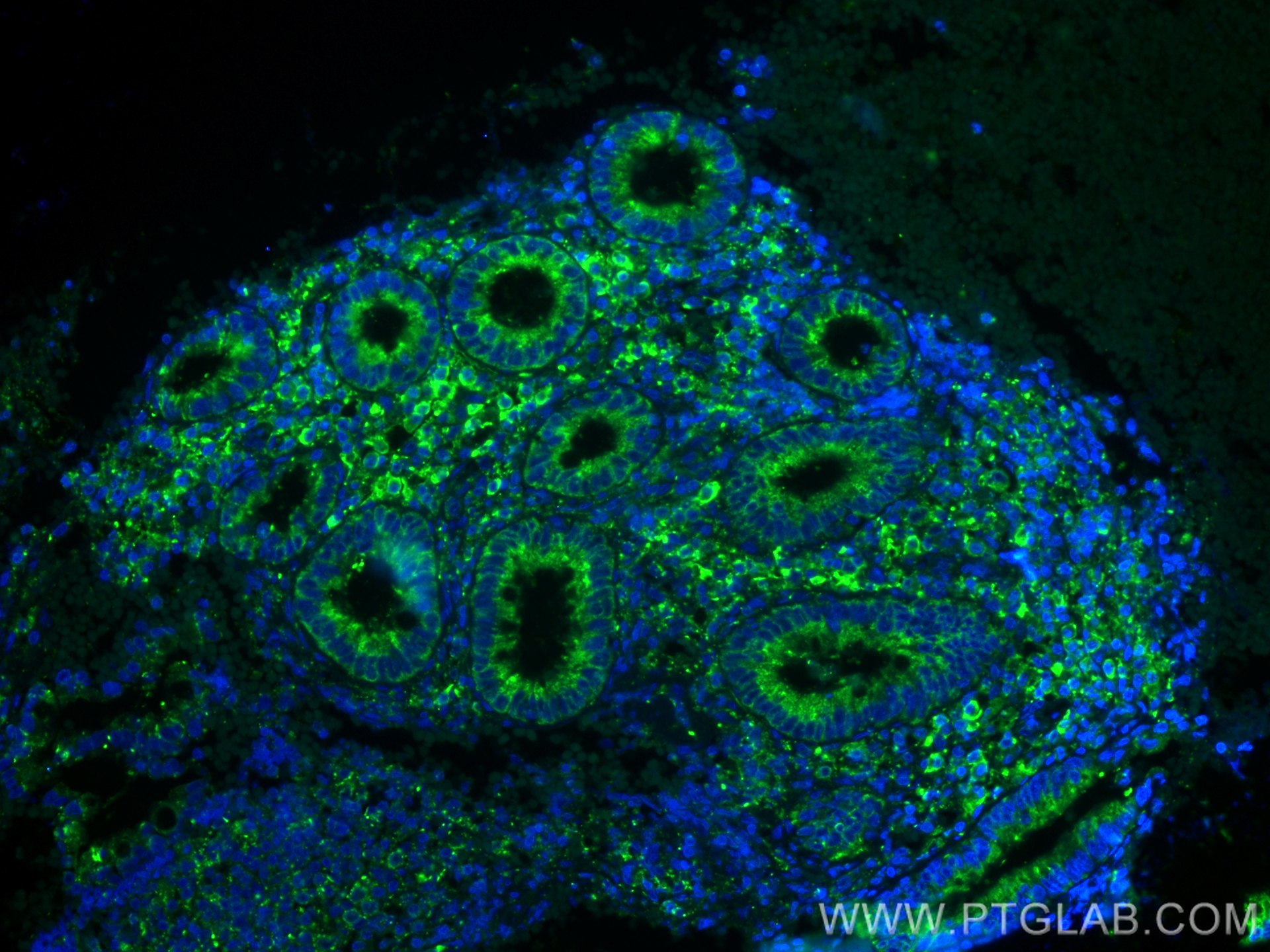 IF Staining of human appendicitis using 10979-1-AP