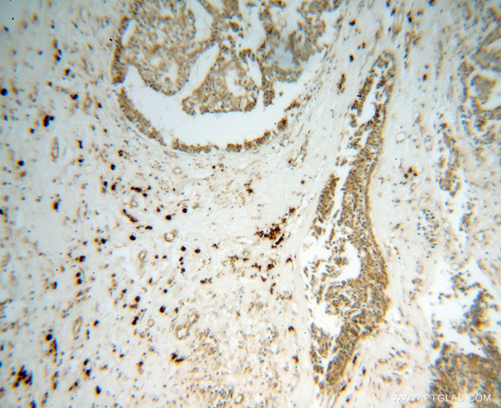 IHC staining of human breast cancer using 10979-1-AP