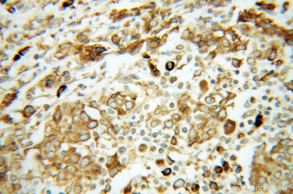 IHC staining of human breast cancer using 14700-1-AP
