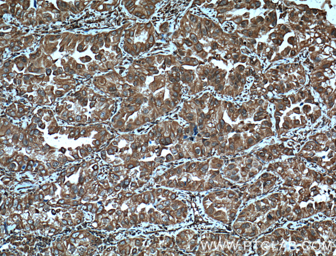 IHC staining of human lung cancer using 60012-1-Ig (same clone as 60012-1-PBS)