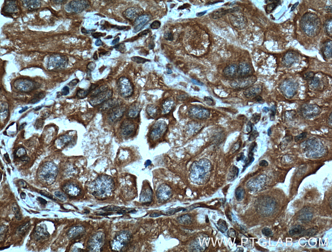 IHC staining of human lung cancer using 60012-1-Ig