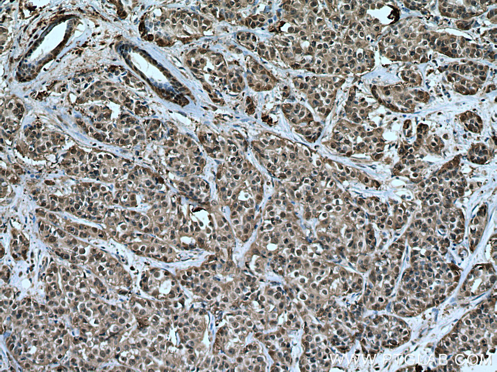 IHC staining of human breast cancer using 10995-1-AP