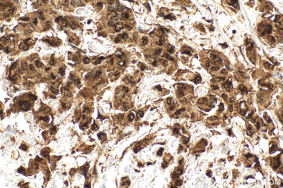 IHC staining of human breast cancer using 10995-1-AP