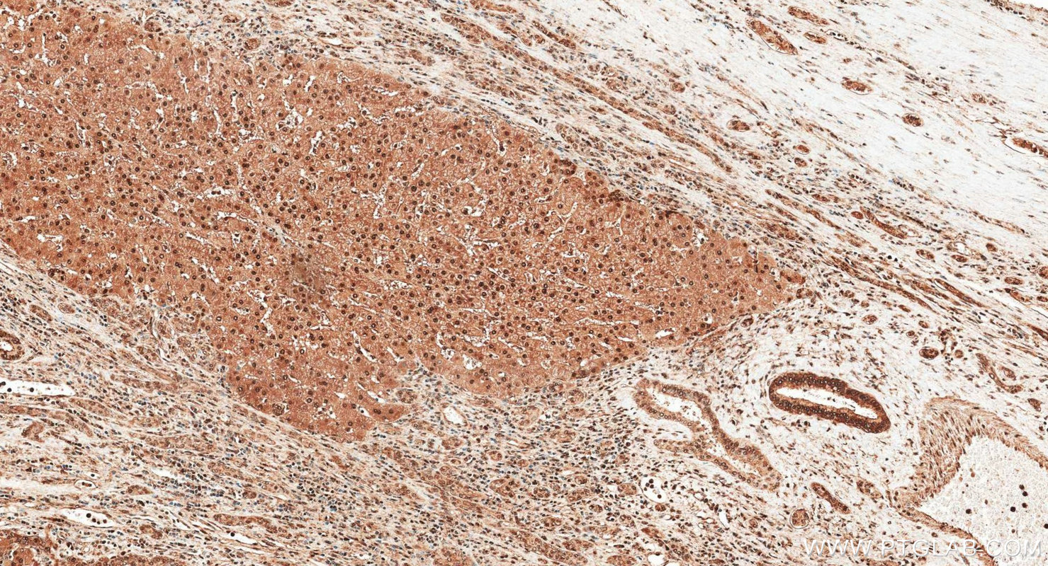 IHC staining of human liver cancer using 10995-1-AP