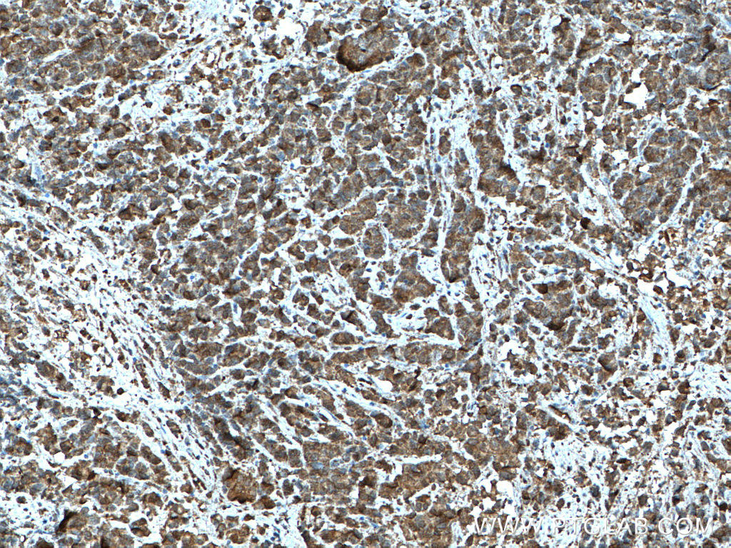 IHC staining of human prostate cancer using 66291-1-Ig