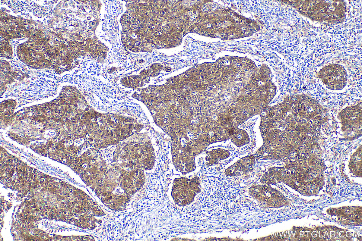 IHC staining of human lung cancer using 32468-1-AP