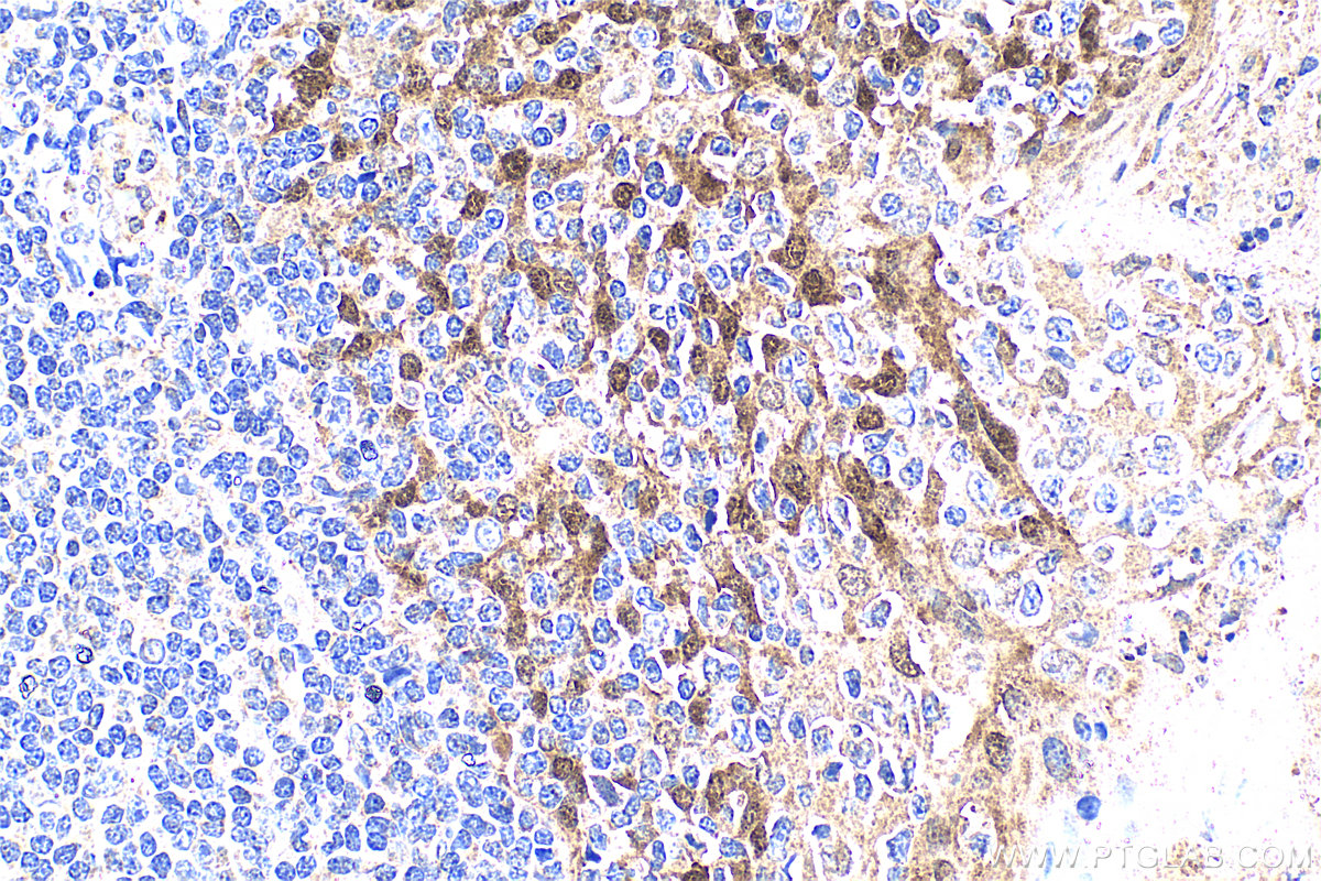 IHC staining of human tonsillitis using 32468-1-AP