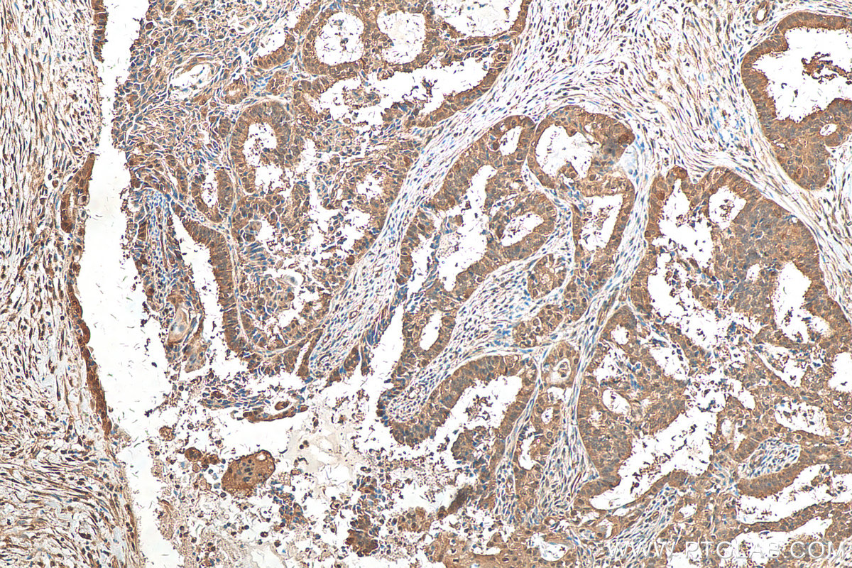 IHC staining of human ovary tumor using 10654-1-AP