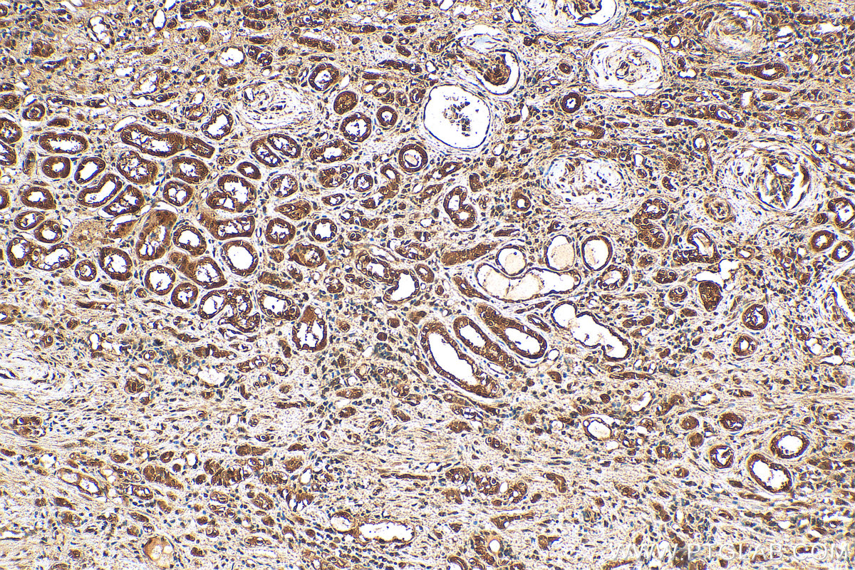 IHC staining of human renal cell carcinoma using 10654-1-AP