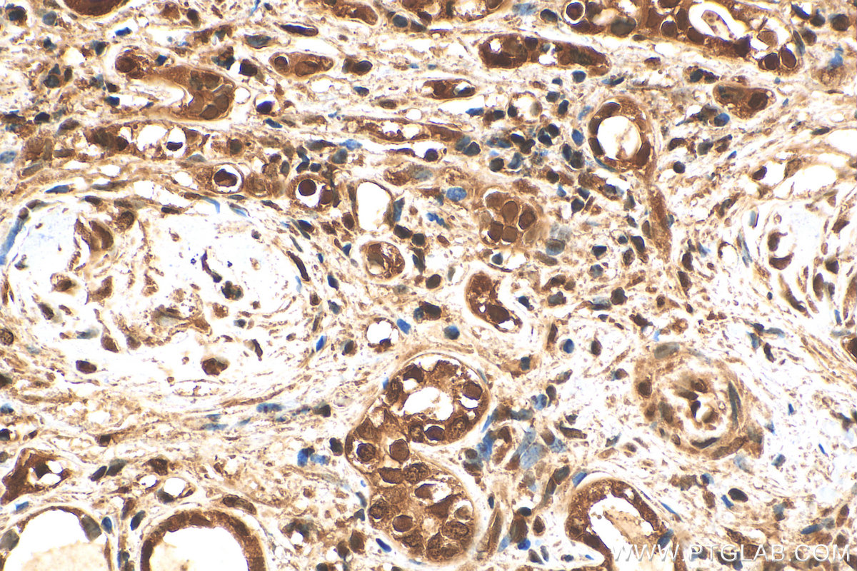 IHC staining of human renal cell carcinoma using 10654-1-AP