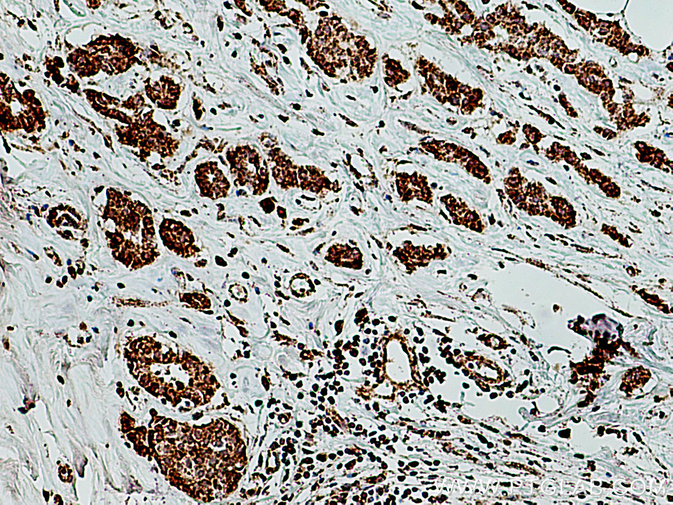 IHC staining of human breast cancer using 14887-1-AP