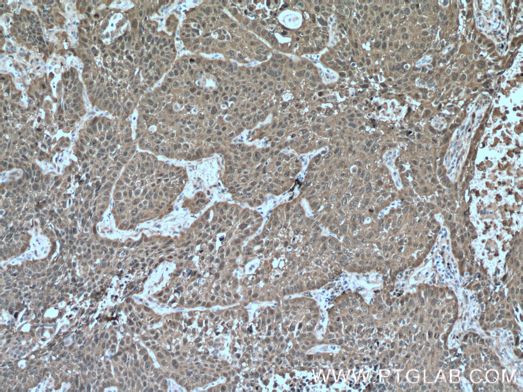 IHC staining of human lung cancer using 18284-1-AP