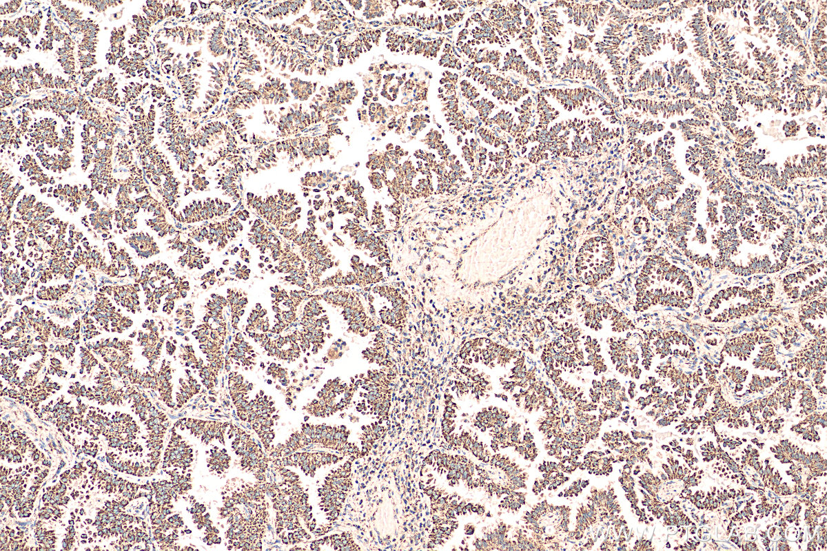 IHC staining of human lung cancer using 15282-1-AP