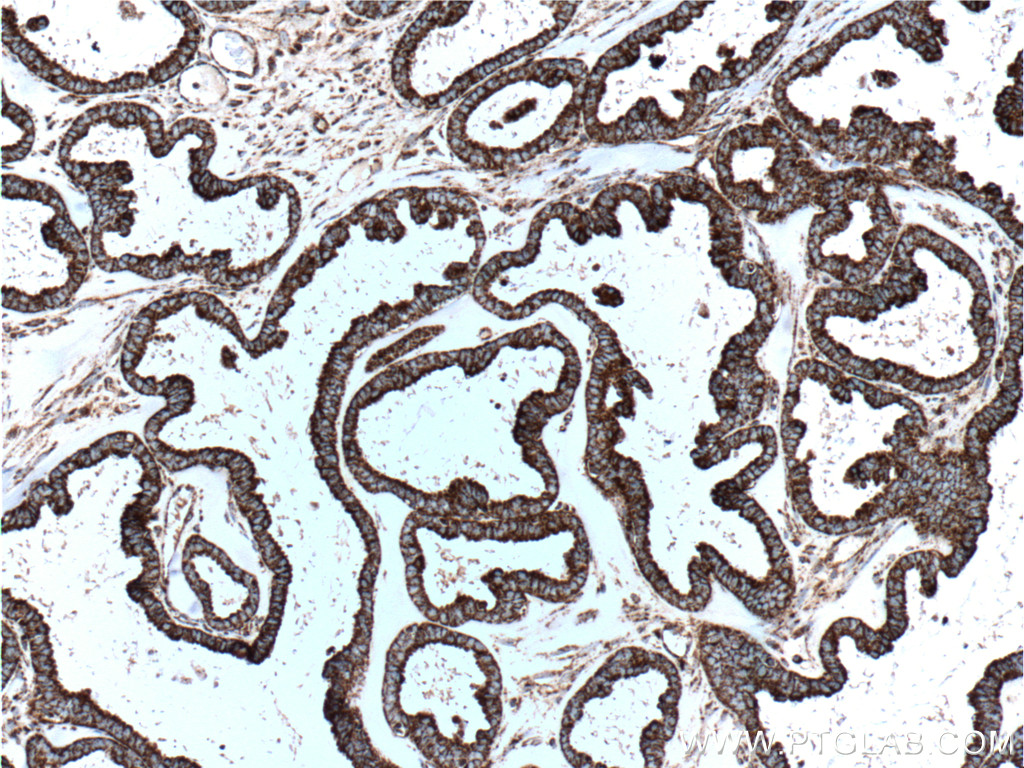 IHC staining of human ovary tumor using 66041-1-Ig (same clone as 66041-1-PBS)