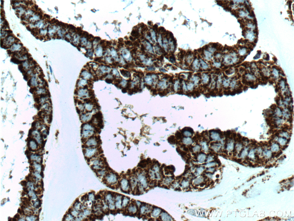 IHC staining of human ovary tumor using 66041-1-Ig (same clone as 66041-1-PBS)