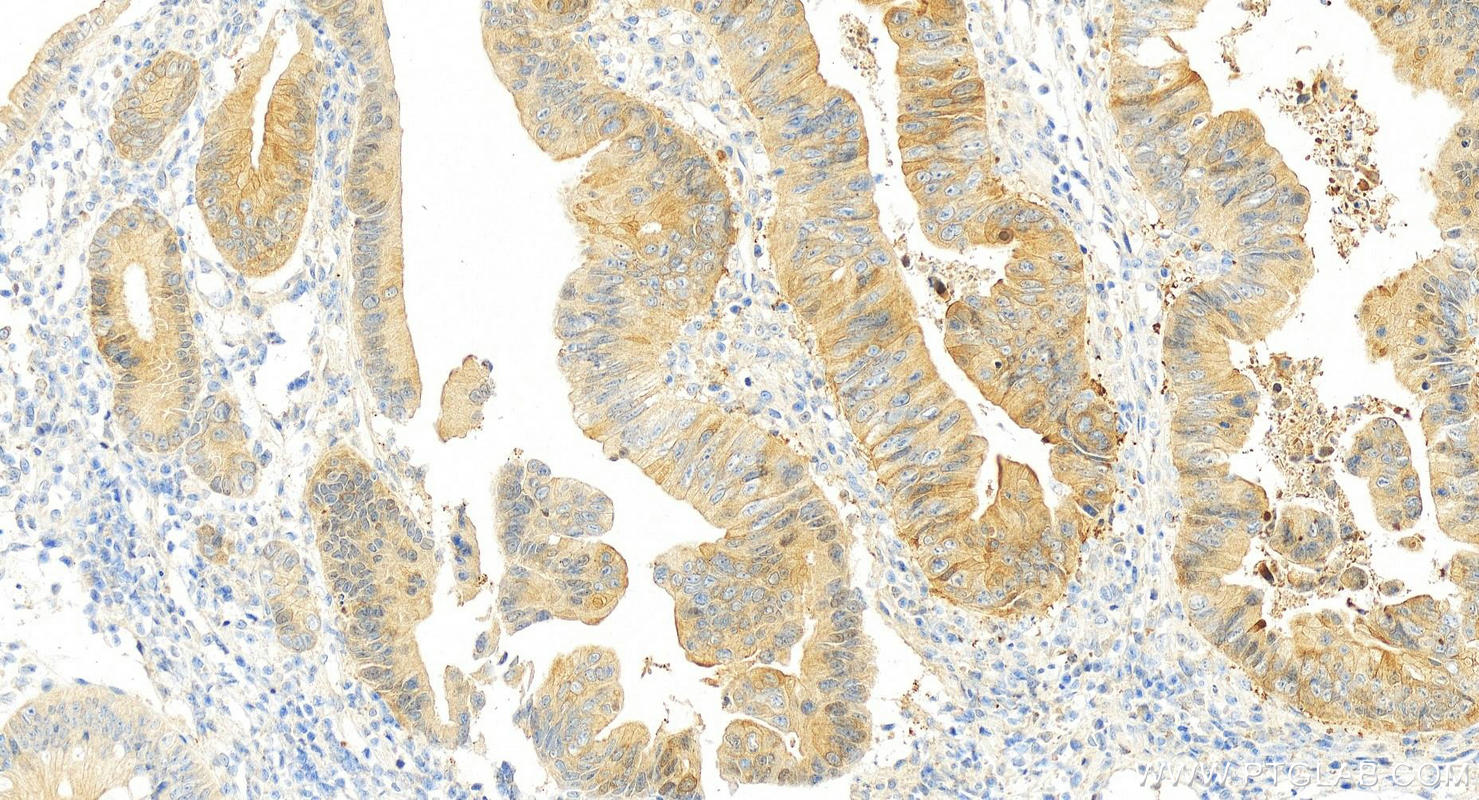 IHC staining of human colon cancer using 13383-1-AP