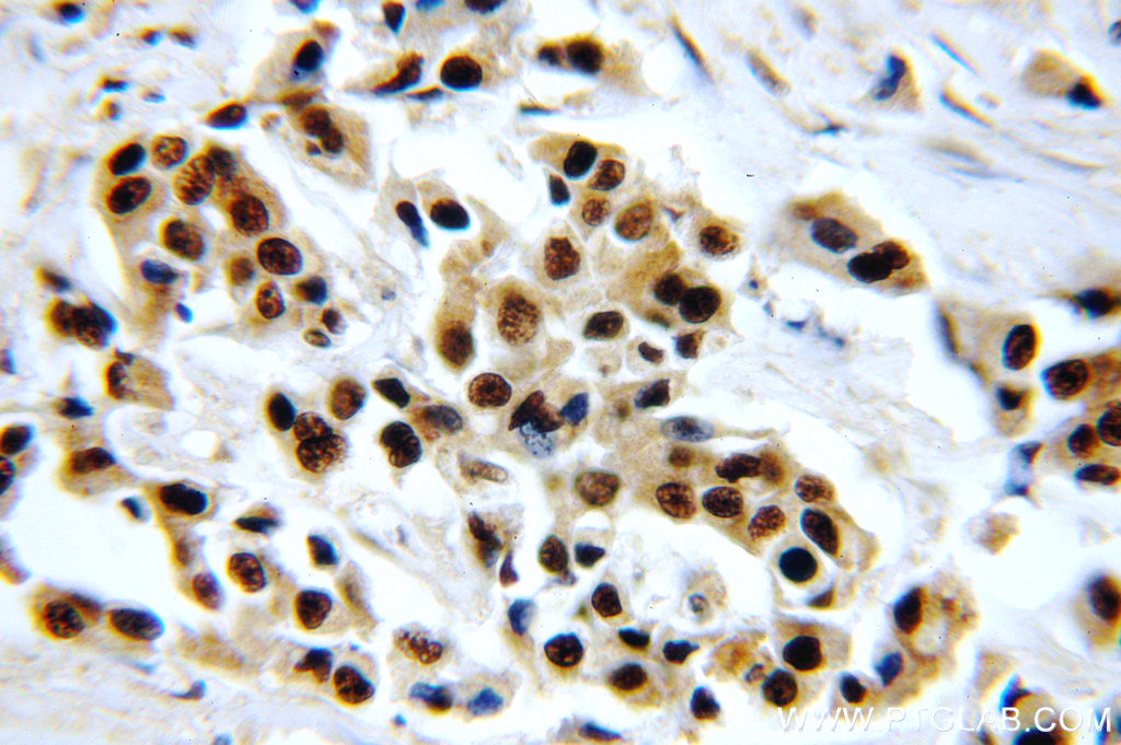 IHC staining of human breast cancer using 20805-1-AP