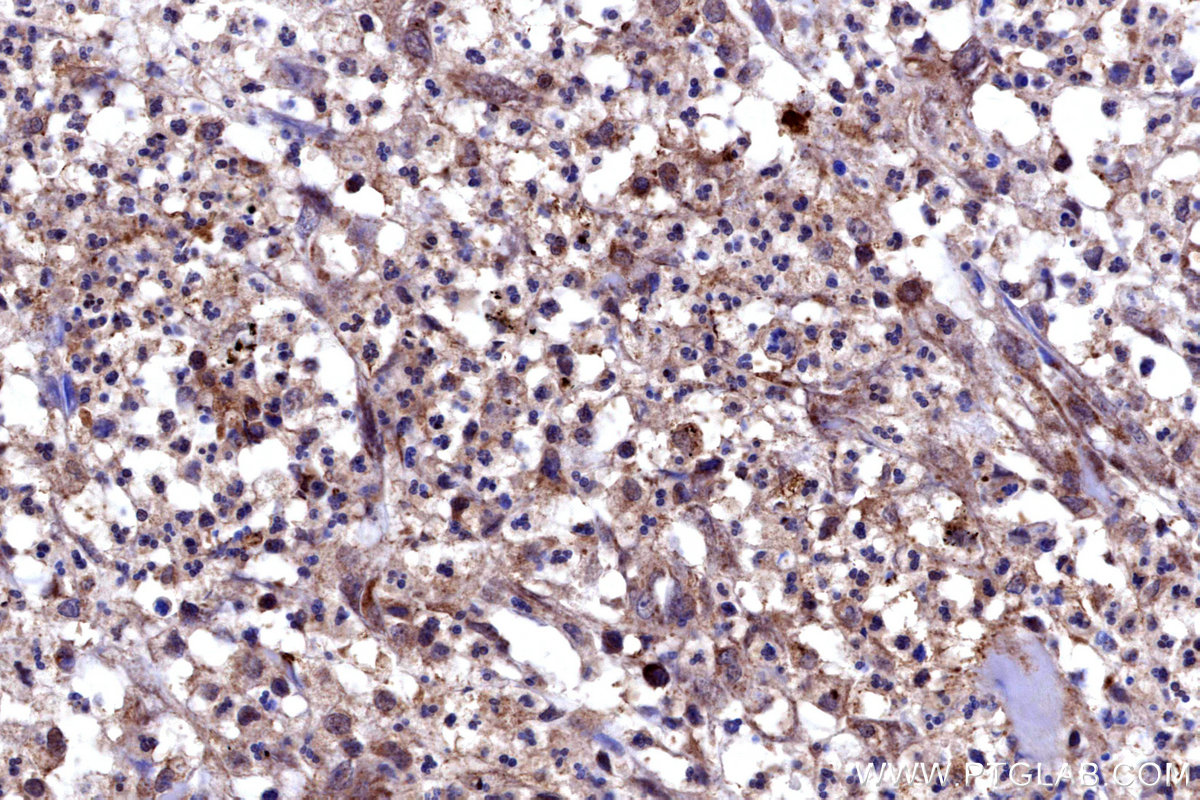 IHC staining of human colon cancer using 16261-1-AP IHC staining of human colon cancer using 16261-1-AP