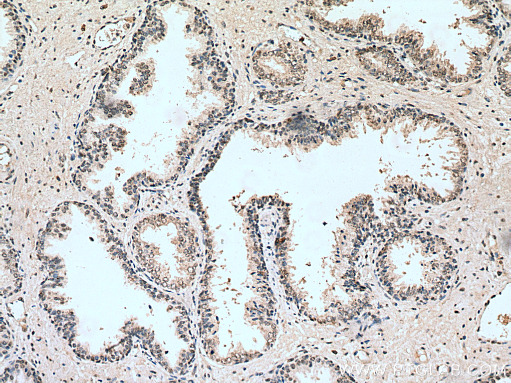 IHC staining of human prostate cancer using 67168-1-Ig (same clone as 67168-1-PBS)