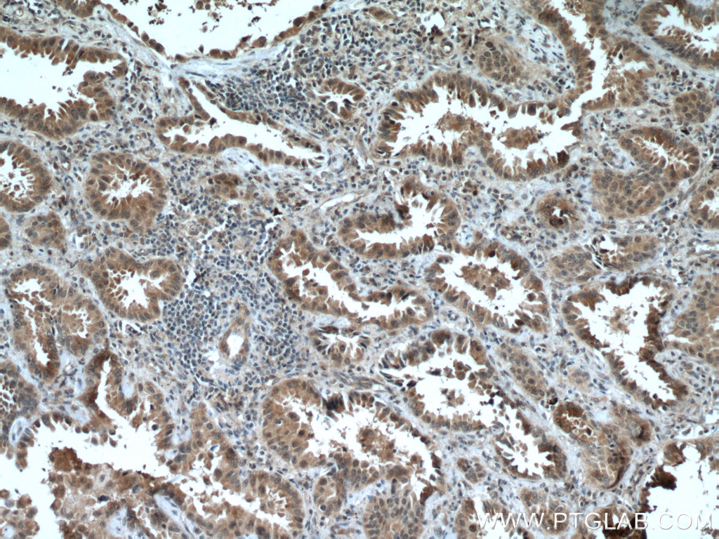 IHC staining of human lung cancer using 19430-1-AP