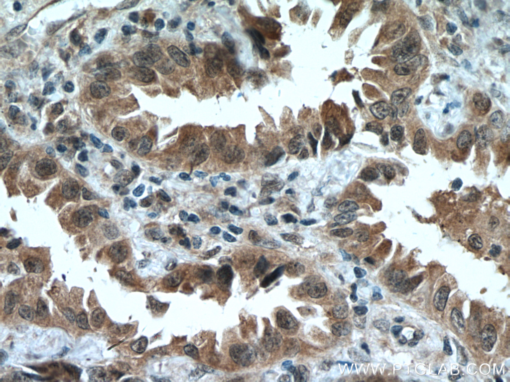 IHC staining of human lung cancer using 19430-1-AP