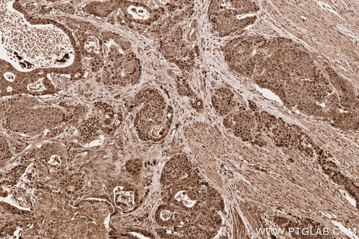 IHC staining of human stomach cancer using 19430-1-AP