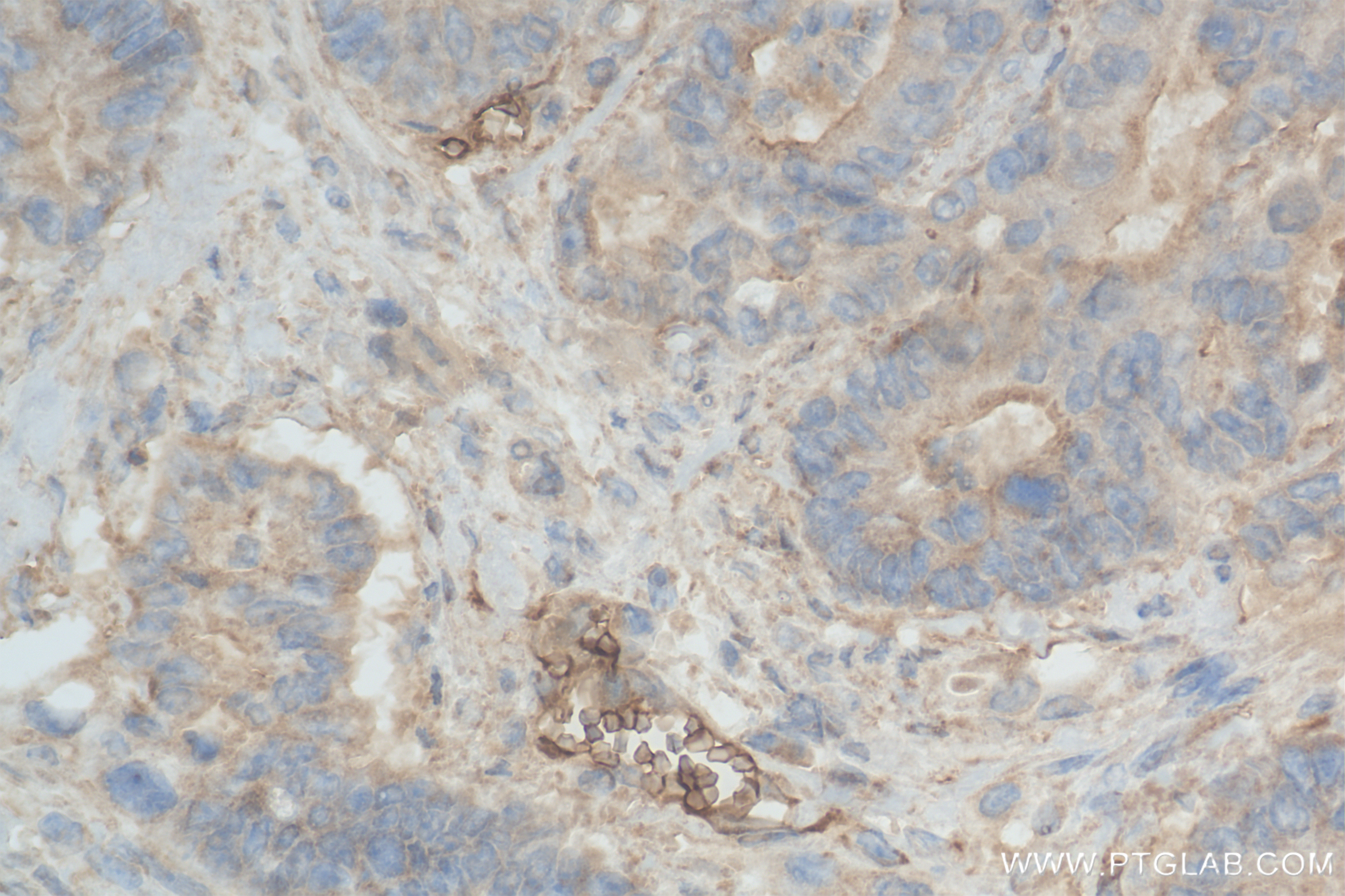 IHC staining of human rectal cancer using 85177-3-RR (same clone as 85177-3-PBS)