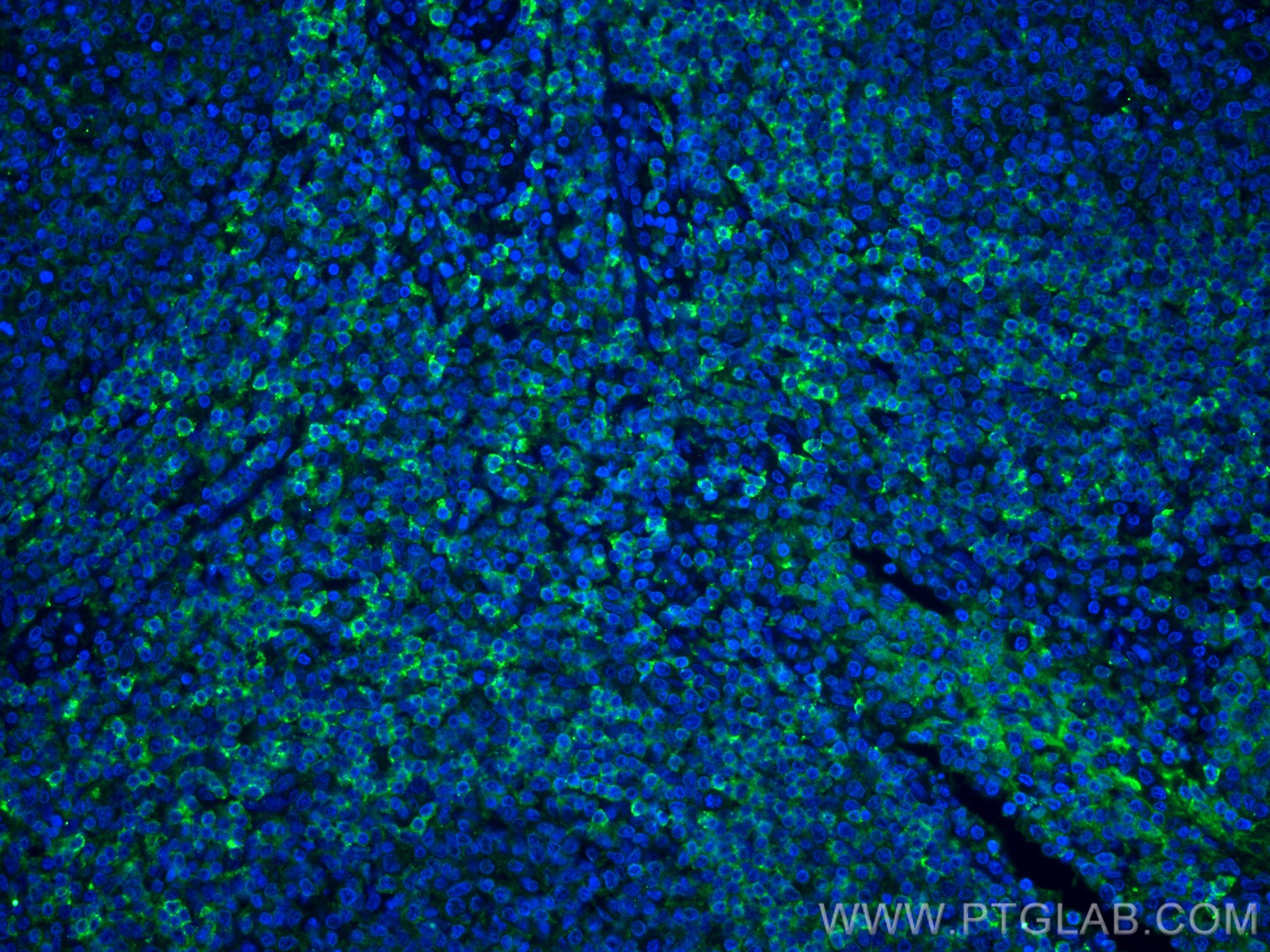 IF Staining of human tonsillitis using 66449-1-Ig (same clone as 66449-1-PBS)