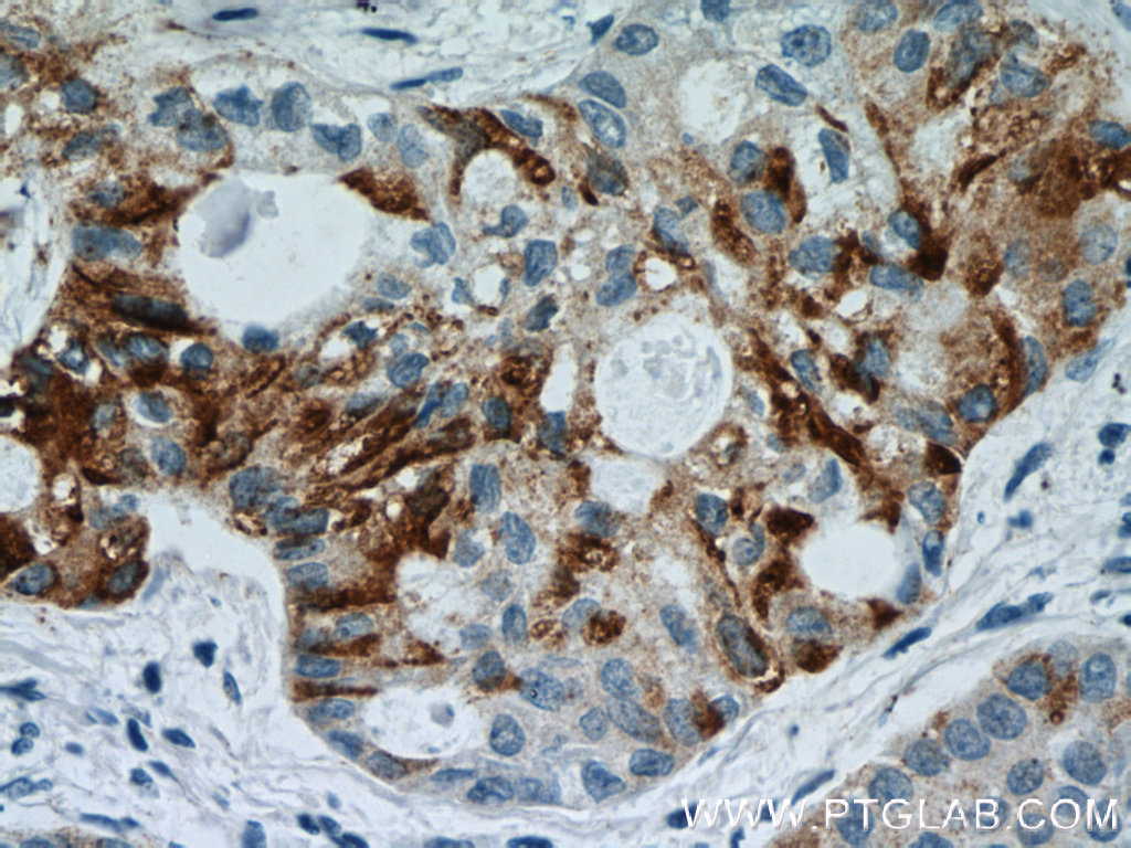 IHC staining of human lung cancer using 51148-1-AP