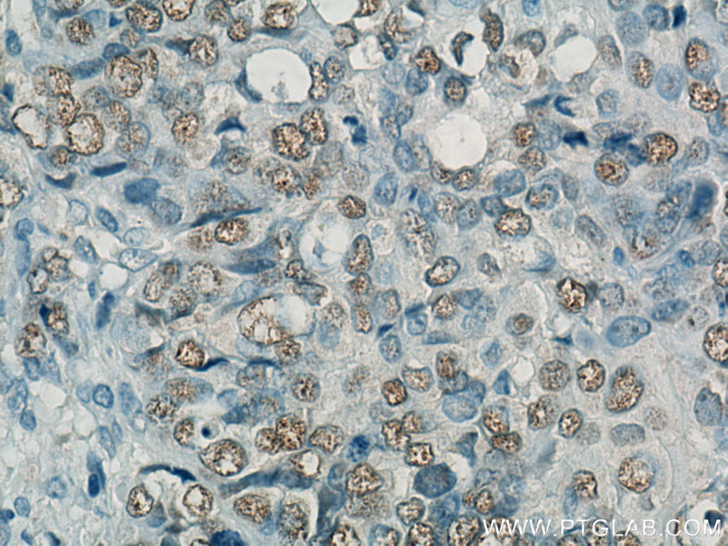 IHC staining of human ovary tumor using Biotin-66467