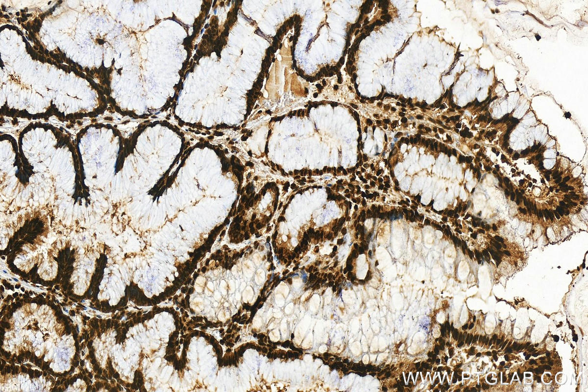 IHC staining of human stomach cancer using 68888-1-Ig (same clone as 68888-1-PBS)