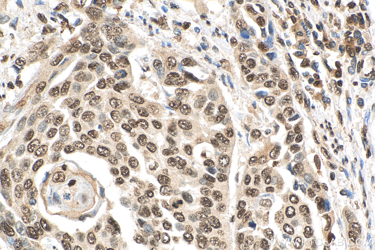 IHC staining of human oesophagus cancer using 17168-1-AP