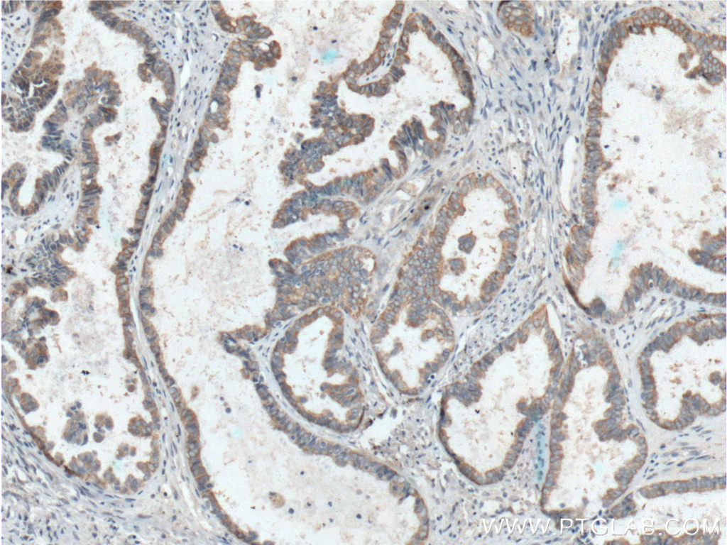 IHC staining of human ovary tumor using 66442-1-Ig