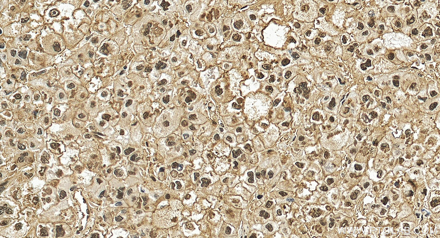 Immunohistochemical analysis of paraffin-embedded human liver cancer tissue slide using <a class='green' href='/productredirect?CatalogNo=81719-2-RR' target='_blank'>81719-2-RR</a> (Hsc70 antibody) at dilution of 1:1000 (under 20x lens). Heat mediated antigen retrieval with Tris-EDTA buffer (pH 9.0). This data was developed using the same antibody clone with 81719-2-PBS in a different storage buffer formulation. IHC staining of human liver cancer using 81719-2-RR (same clone as 81719-2-PBS)