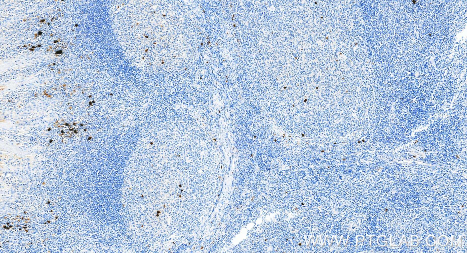 IHC staining of human tonsillitis using 98723-2-RR
